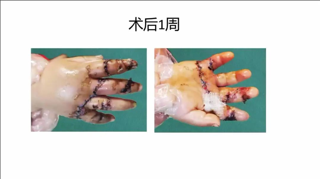 聚焦顯微外科|葫蘆島市醫(yī)學會顯微外科學分會第一屆第二次學術(shù)會議順利召開(圖25)